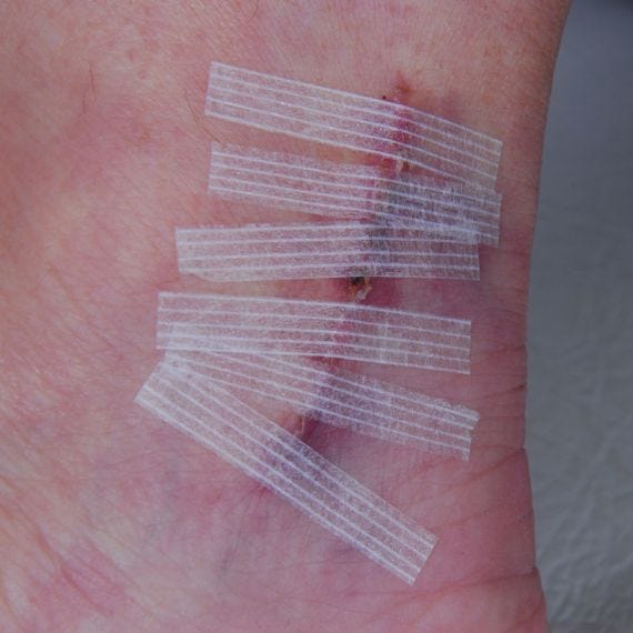 Asguard Surgistrip Reinforced Skin Closures 6mmx75mm